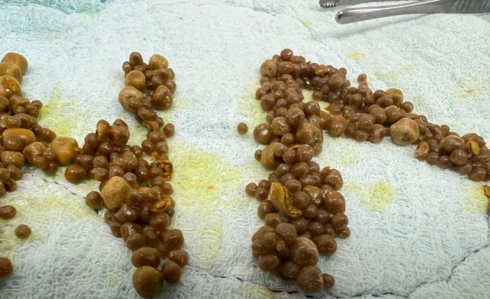 Zonguldak'ta hastanın safra kesesinden 1250 taş çıkarıldı