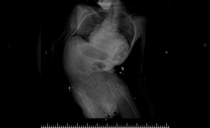 Samsun'da bir hastanın omurga eğriliği 5,5 saatlik ameliyatla düzeltildi