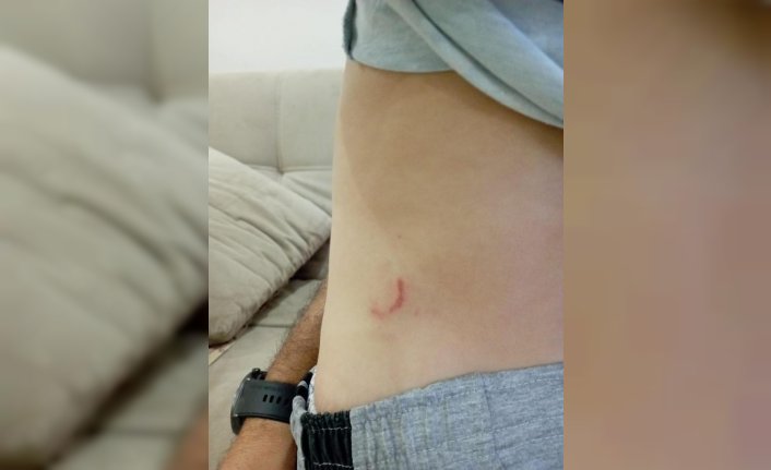 Karabük'te sokak köpeklerinin saldırısına uğrayan çocuk yaralandı