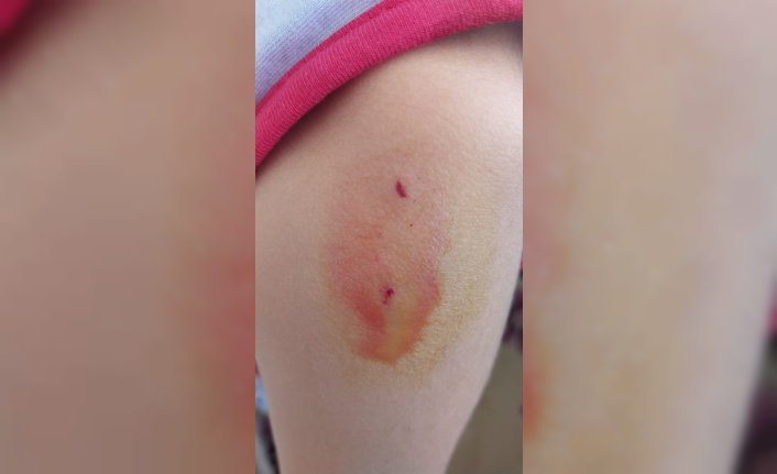 Kastamonu'da sahipsiz köpeklerin saldırdığı çocuğu babası kurtardı