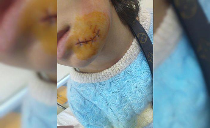 Rize'de sokak köpeğinin saldırısına uğrayan çocuk yüzünden yaralandı