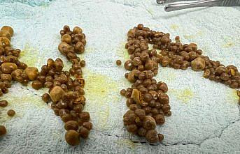 Zonguldak'ta hastanın safra kesesinden 1250 taş çıkarıldı