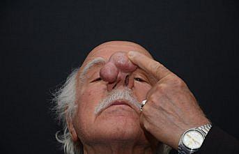 84 yaşındaki hastanın burnundan 100 gramlık kitle alındı