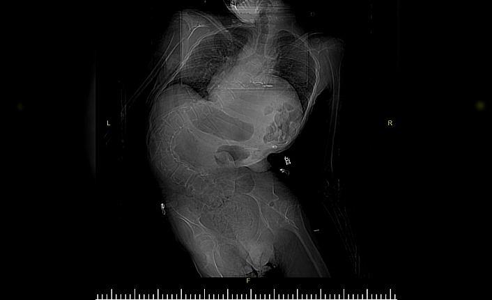 Samsun'da bir hastanın omurga eğriliği 5,5 saatlik ameliyatla düzeltildi