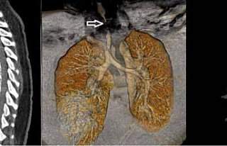 Trabzon'da Kovid-19 tedavisinin ardından soluk borusu...