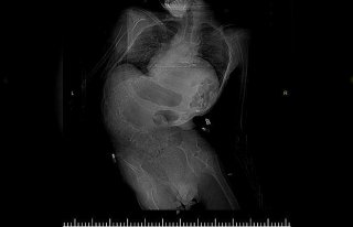 Samsun'da bir hastanın omurga eğriliği 5,5...